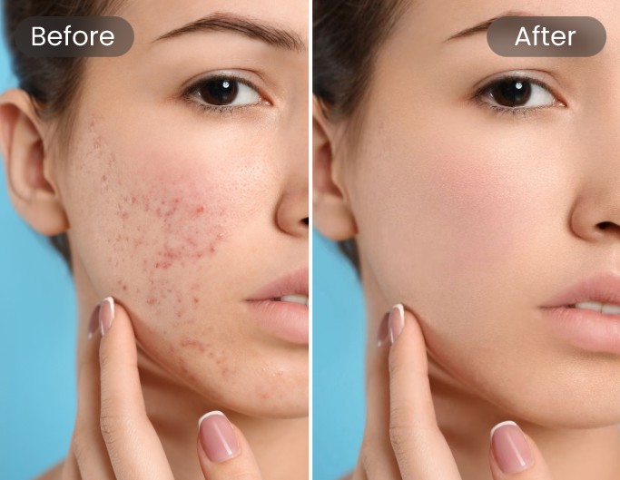 Skin Softening