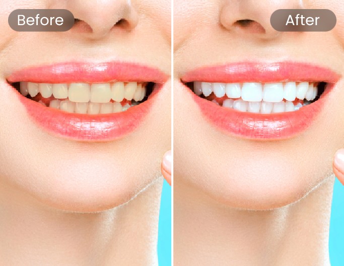 Teeth Whitening