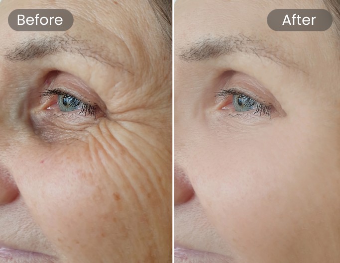 Wrinkle Removal