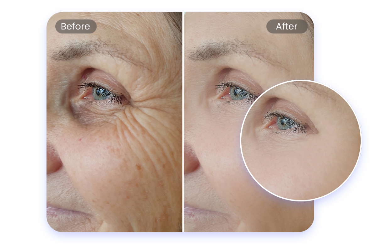 Before and after comparison showing that removing eye wrinkles in a photo