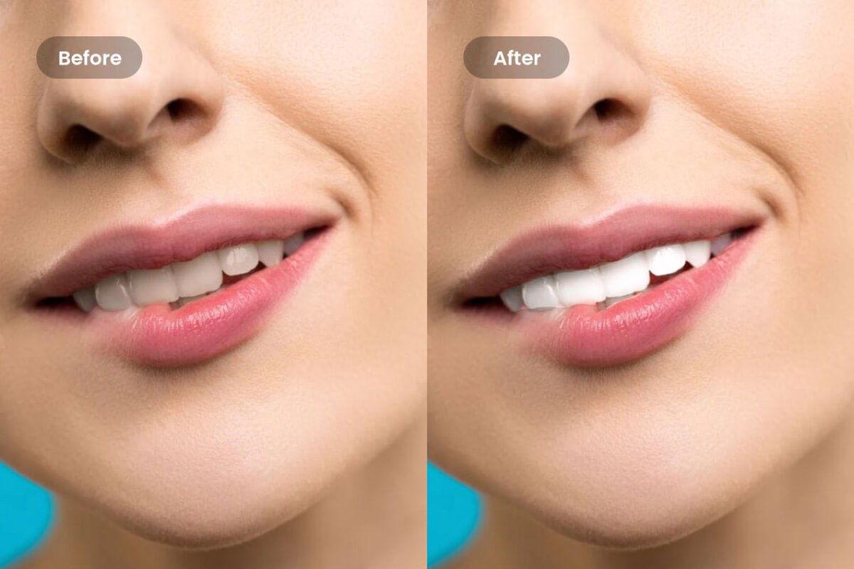 Blanchiment des dents sur photo